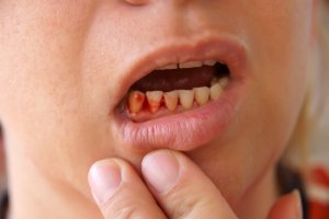 Gum disease