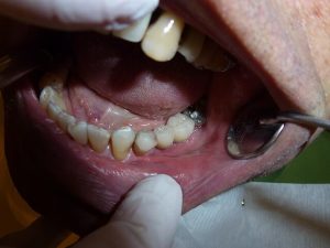 mercury amalgam
